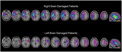 Statistical Learning Impairments as a Consequence of Stroke